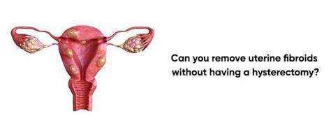 Can You Remove Uterine Fibroids Without Having A Hysterectomy