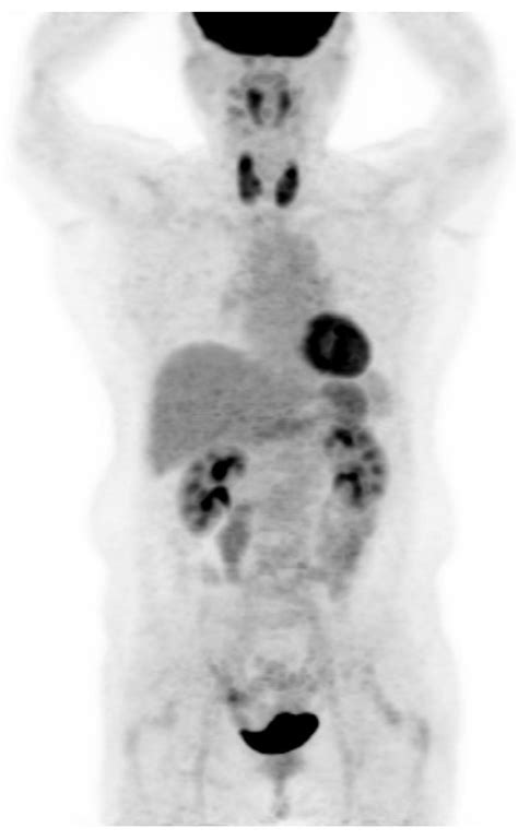 Diffusely Increased 18f Fdg Uptake In The Thyroid Gland And Risk Of