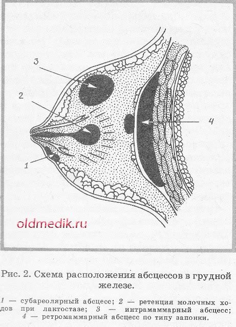 Острый мастит