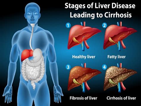 Foods To Avoid If You Have Fatty Liver