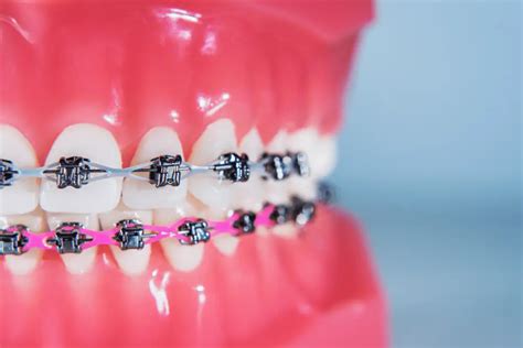 Los Brackets Clinica Dental Sonrisa Segura