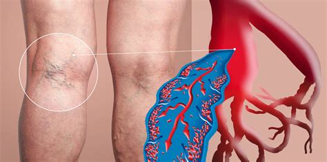 Deep Vein Thrombosis Dvt Apex Vascular