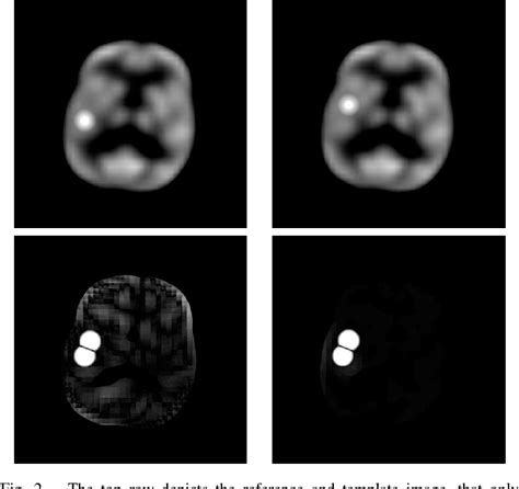 Figure 2 From Difference Imaging Of Inter And Intra Ictal Spect Images