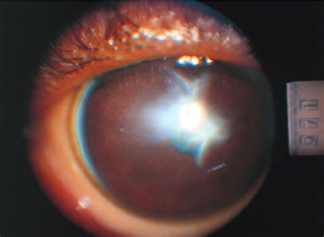 corneal scar