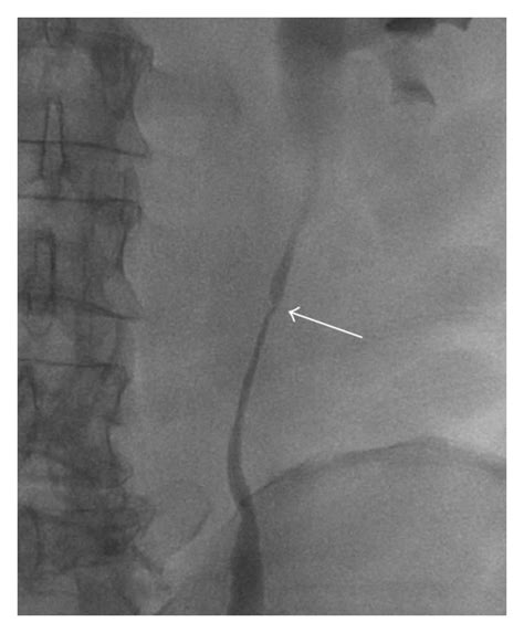 Retrograde Ureteropyelography Showing Ureteral Stenosis At The L3