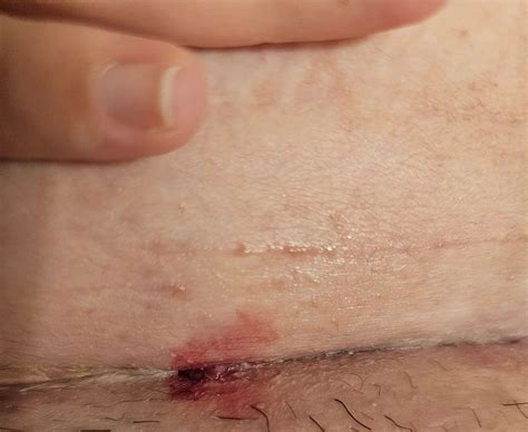 C Section Scar Bleeding Babycenter