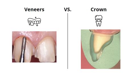 Crowns vs veneers for front teeth: Which is best for you?