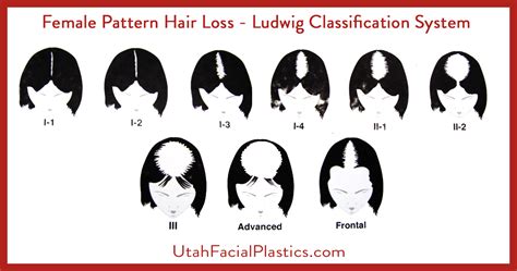 What Is Female Pattern Hair Loss? - Female pattern hair loss