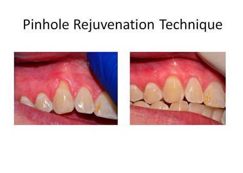 Dr Robert L Franklin Jr Pinhole Technique Pst Before And Afters