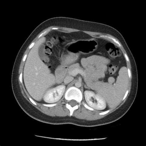 Borderline Mucinous Tumor Ovary Image