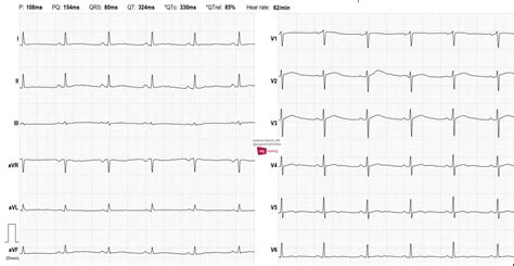 Long QT Syndrome,Look Closely and Do Not Trust the ECG-Computer | ECG ...