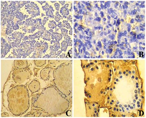 Btg Expression In Thyroid Carcinoma Diagnostic Indicator And