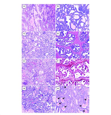 Histopathologic Findings Of Uterine Corpus Mla A Papillary Pattern