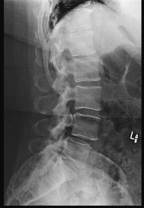 Lumbar Laminectomy For Synovial Cyst