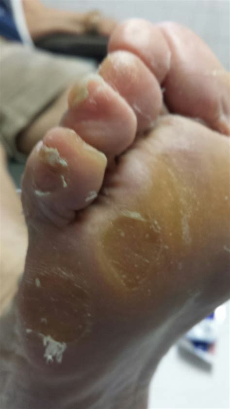 Gallary Of Foot Diseases And Abnormalities Foot Care Specialist Doctor Anthony Chionis