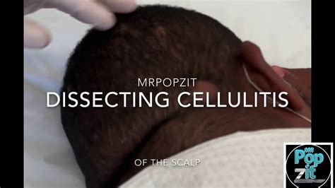 Dissecting Cellulitis Of The Scalp Deep Pus Pocket Popped And Pressure Relieved Chronic