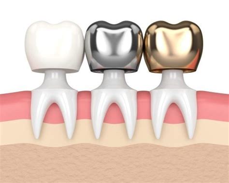 Dental Crown Core Buildup, What is it?, Costa Rica Dental Team Dentists