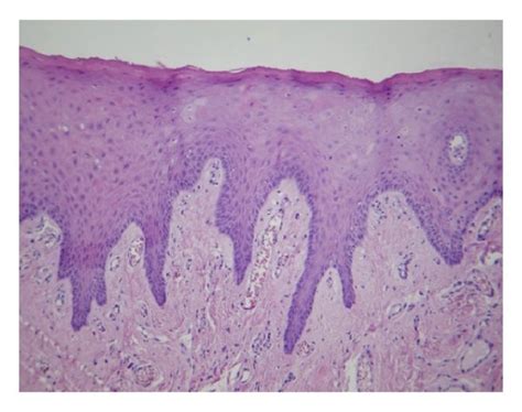 A B And C Epithelial Lining Of Inflammatory Fibrous