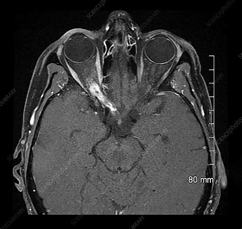 Optic Nerve Glioma MRI