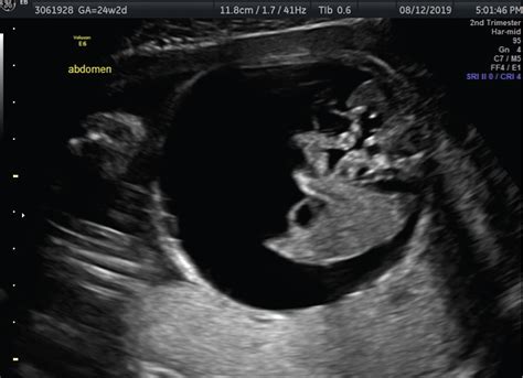 antenatal management   trimester oligohydramnios  evolving