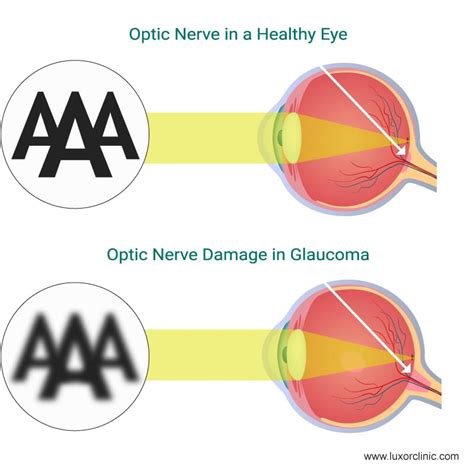 Glaucoma Causes Symptoms Treatment