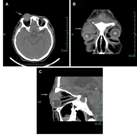 Figure 1 From An Isolated Orbital Mass With Proptosis And Diplopia An