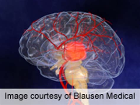 'Clot-Buster' Drug May Still Be Best Stroke Treatment - Consumer Health News | HealthDay