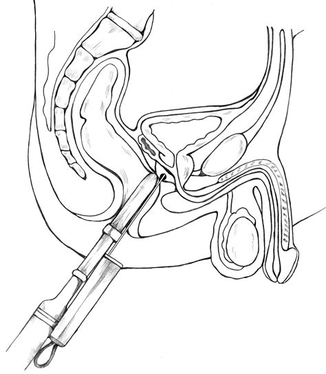 Transrectal Prostate Biopsy With An Ultrasound Probe Guiding The Needle To The Prostate Media