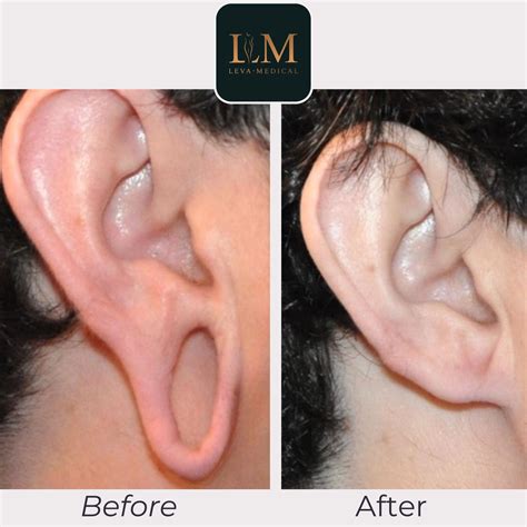 Earlobe Repair Before And After Ear Lobe Surgery Leva Medical