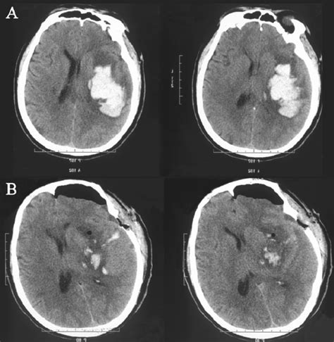 Cerebral Hemorrhage In The Basal Ganglia A Preoperative B