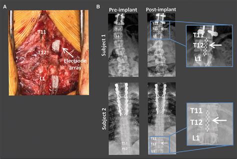 Figure 1 From Electrophysiological Guidance Of Epidural Electrode Array Implantation Over The