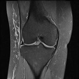 Prepatellar Bursitis Image Radiopaedia Org