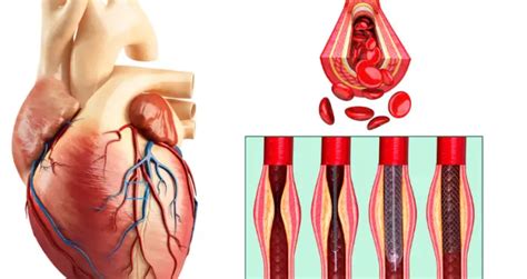 Everything You Need To Know About Heart Stents In South Africa A