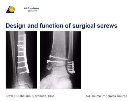 Design and function of surgical screws | PPT