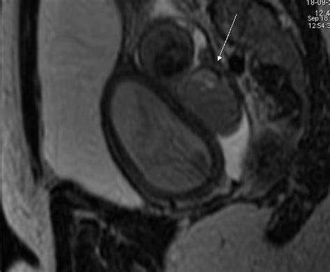 Hematometra with hematosalpinx-MRI - Sumer's Radiology Blog