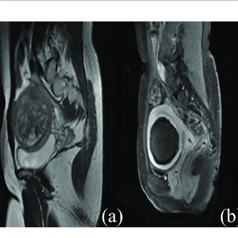 Contrast Enhanced Mr Images Before And After Hifu Treatment A The