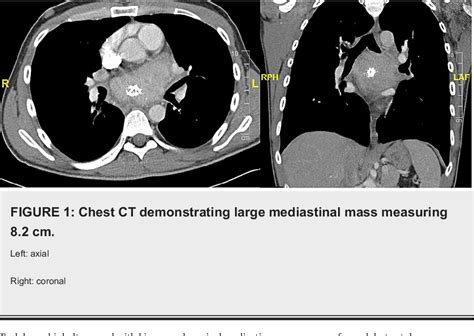 Figure 1 From Castleman Disease Presenting As A Mediastinal Mass