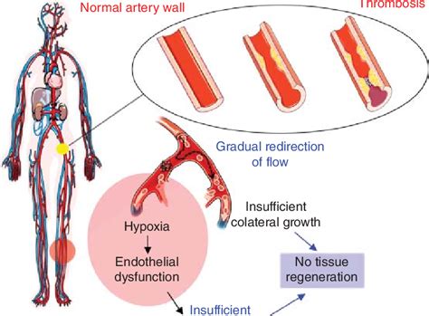 2 Peripheral Arterial Disease In The Lower Limb Is Characterized By