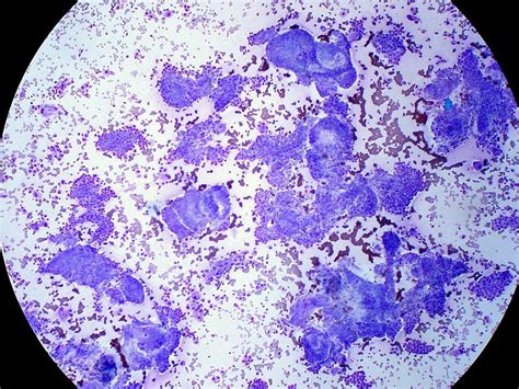 Figure Papillary Thyroid Carcinoma FNA Giemsa StatPearls