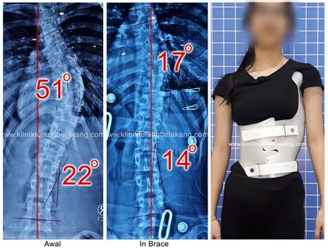 Apakah Skoliosis Lebih Dari Derajat Masih Bisa Diobati