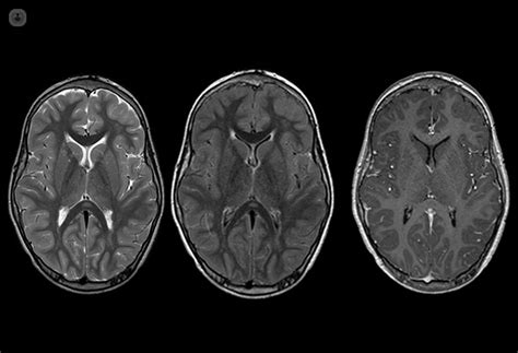 Neuroradiology What Is It Symptoms And Treatment Top Doctors