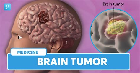 Brain tumor: Types, Symptoms, Diagnosis and Treatment