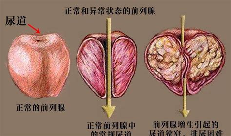 关于前列腺的冷知识，你知道多少？ 进行 男性 按摩