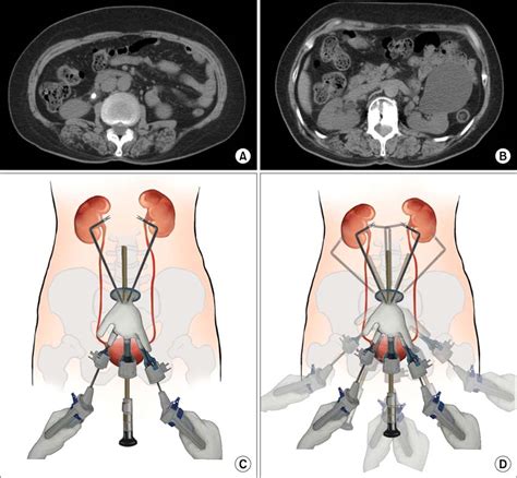 Concomitant Laparoendoscopic Single Site Surgery For Ureterolithotomy