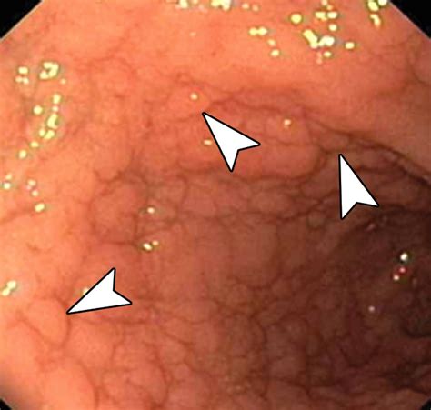 Endoscopy In Celiac Disease At Conrad Hughes Blog