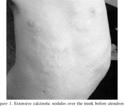 Figure From Rapid Improvement Of Calcinosis In Juvenile