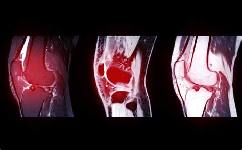 New concepts in ACL injury management