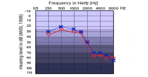 The Basics Of An Audiogram Whisper Audiology Hearing Clinic Stoney