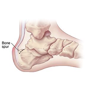 Foot Surgery: Bone Spurs | Saint Luke's Health System