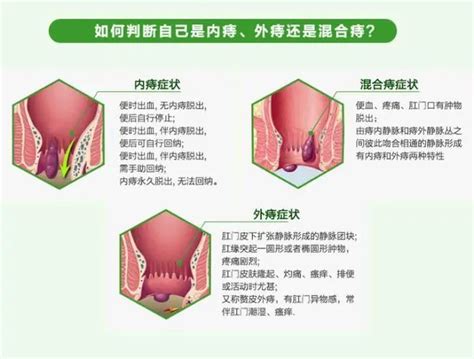 痔疮长什么样？痔疮是怎么引起的？腾讯新闻